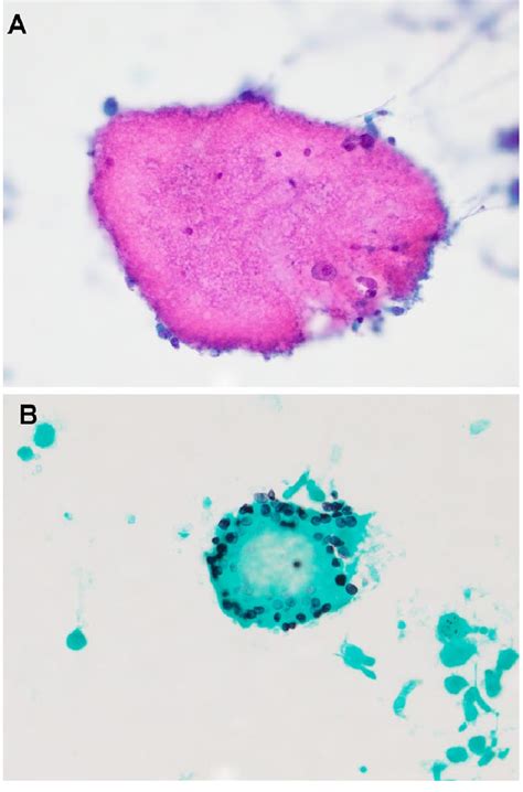 Pneumocystis Jirovecii A Pneumocystis Jirovecii Infections Lead To Download Scientific