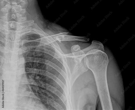 X- ray of collarbone Stock Photo | Adobe Stock