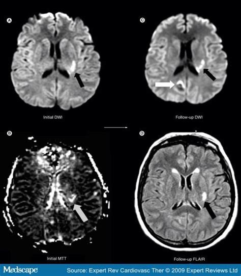 Neuroimaging Of Ischemic Stroke With Ct And Mri