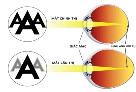 Mắt Là Thấu Kính Gì Khám Phá Cấu Tạo Và Chức Năng đặc Biệt Của Mắt