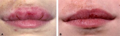 Cheilitis Granulomatosa Treated With Intralesional Corticosteroids And