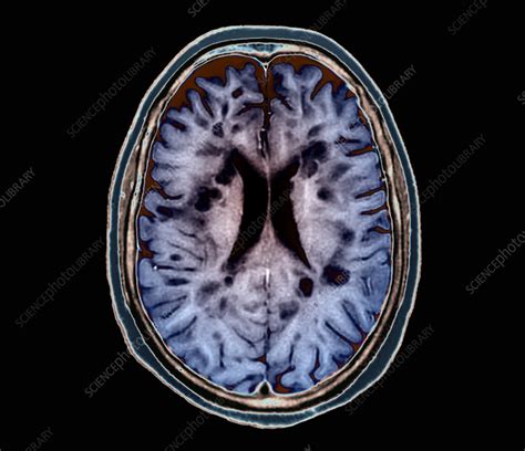 Multiple Sclerosis Mri Scan Stock Image C0551602 Science Photo Library