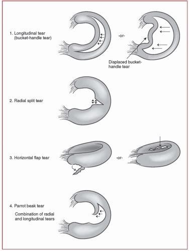 Meniscal Repair Musculoskeletal Key