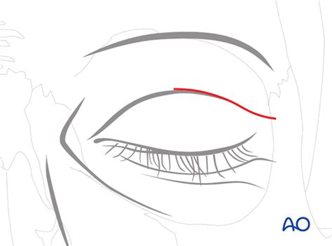 Contouring for Supraorbital ridge/orbital roof malposition