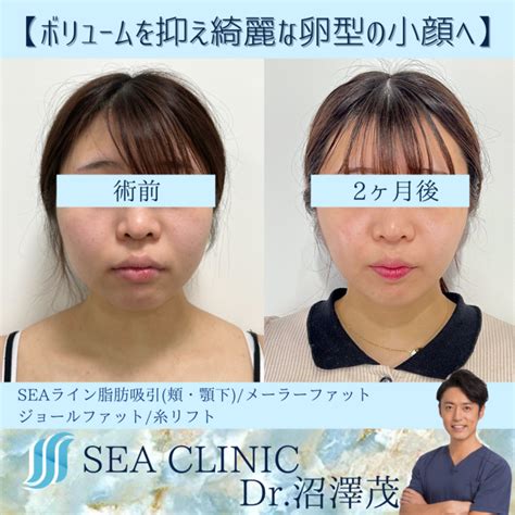 ボリュームを抑え綺麗な卵型の輪郭へ Sea Clinic −シークリニック 銀座― 理想を叶える小顔治療