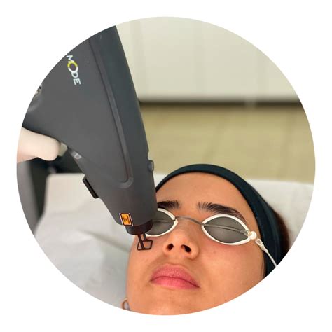 Melasma Laser Acroma NÓS Medicina