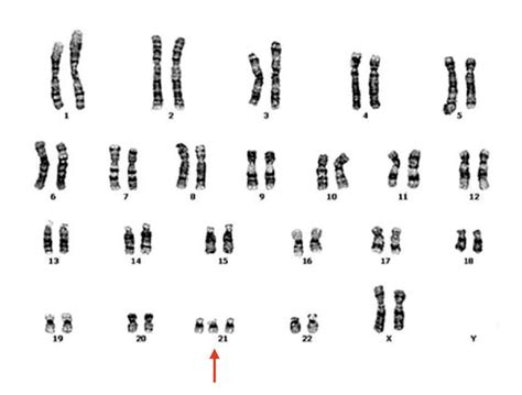 Trisomy 21 (Down Syndrome): Definition, Causes, Symptoms, Pictures and Diagnosis