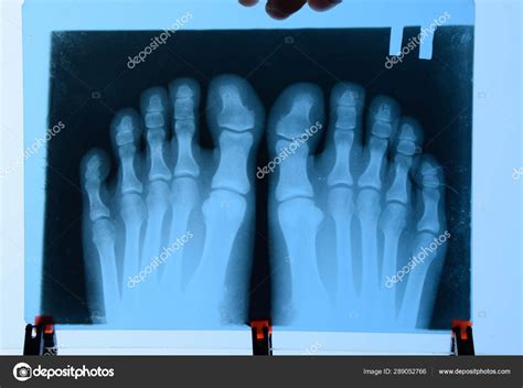 Broken little toe x ray: The request could not be satisfied