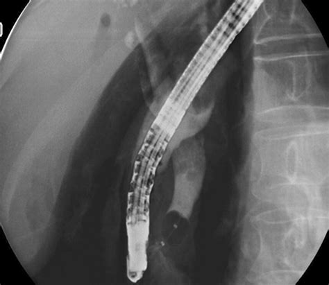 Retroperitoneal Air Was Noted After Endoscopic Retrograde Download