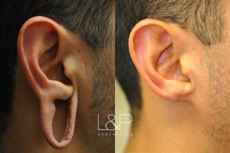 Earlobe Repair Before And After Photos Case 67 Palo Alto San Jose