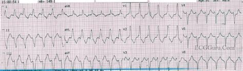 V Tach | ECG Guru - Instructor Resources