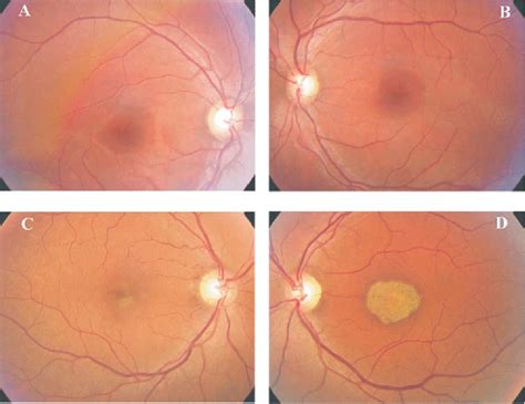 Figure From Progressive Cone Dystrophy Associated With Mutation In