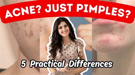 Acne Vs Pimples Top Differences How To Tell What Your Breakouts