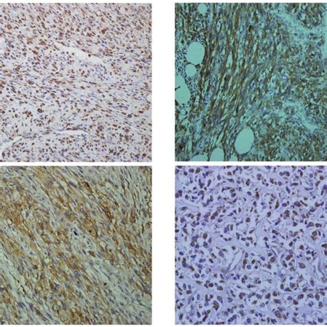 Immunohistochemical staining of HIF 1α CA9 GLUT1 and VEGF in high