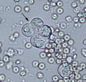 Neoplastic cell and RBC