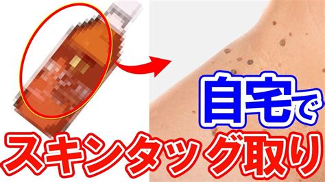 【衝撃】スキンタッグが自然に取れると噂の5つの裏技！～首イボの取り方～ Youtube