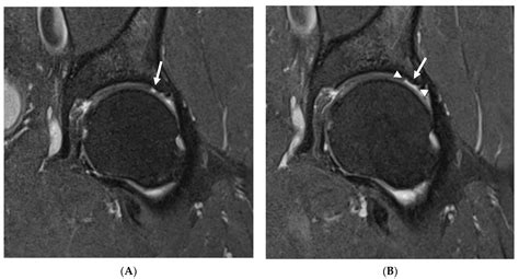 Osteoarthritis Hip Mri