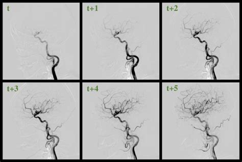 Dsca A Digital Subtraction Angiography Sequence Dataset And Spatio