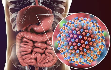 Hepatitis C Liver Disease