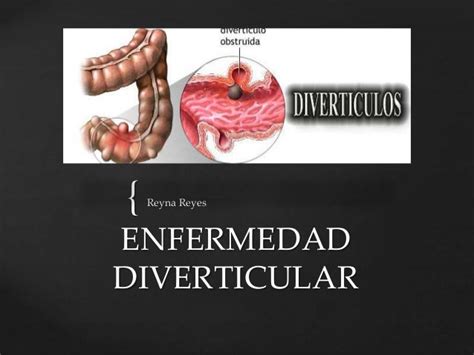 Enfermedad Diverticular