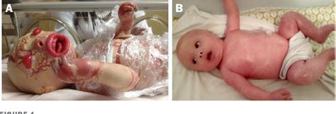 Figure 1 From Improved Management Of Harlequin Ichthyosis With Advances In Neonatal Intensive