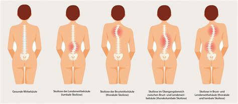 Sehr Leichte Skoliose