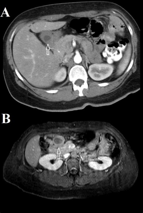 Heterotopic Pancreas In Excluded Stomach Diagnosed After Gastric Bypass Surgery Bmc Surgery