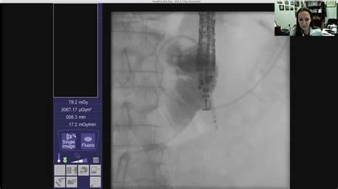 EUS guided Gastroenterostomy - YouTube