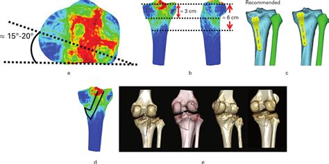 3d Mapping And Classification Of Tibial Plateau Fractures Bone And Joint