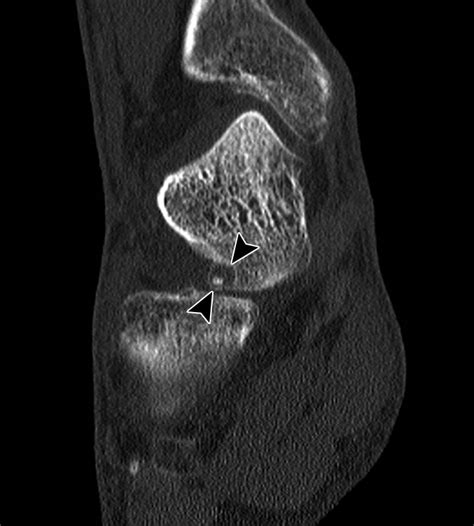 Ct Guided Percutaneous Cryoablation For Osteoid Osteoma Initial