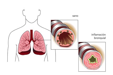 Asma Qué es causas síntomas tratamiento y consejos FisioOnline