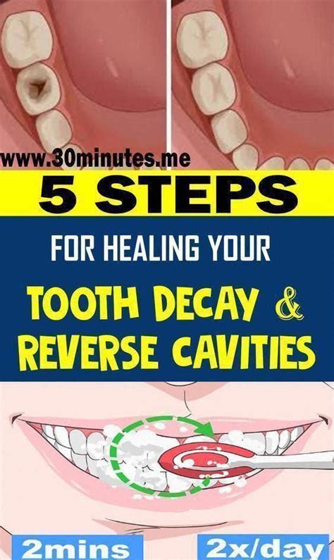 Get Rid Of Cavities And Tooth Decay Artofit