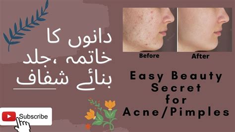 Pimple Treatment Acne Treatment Pimple Khatam Karne Ka Tarika Zuni