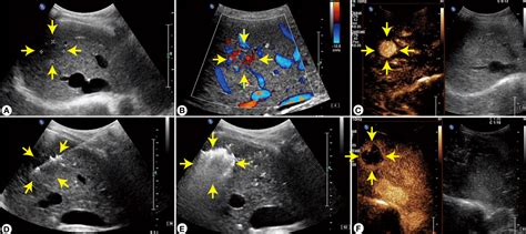 Frontiers Ultrasound Guided Thermal Ablation Versus Laparoscopic Surgery For Focal Nodular