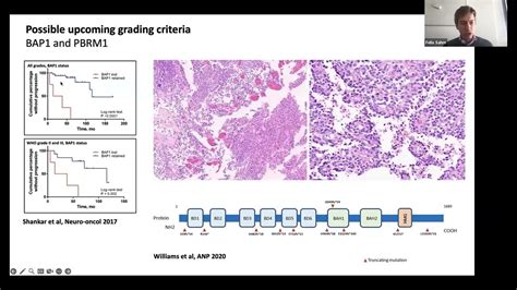 Eans Webinar Meningiomas Youtube