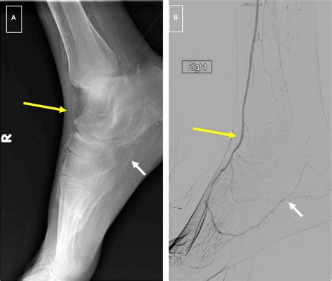 Frontiers Medial Artery Calcification In Peripheral Artery Disease