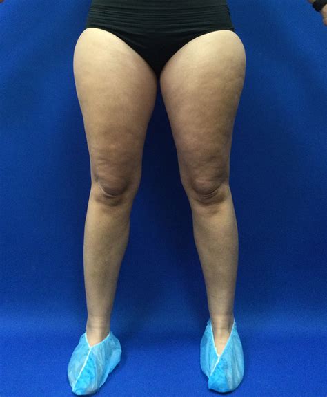 Lipedema Stages - Lipedema MD