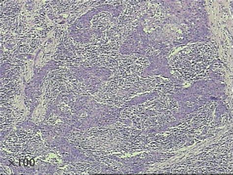 Figure From Pulmonary Lymphoepithelioma Like Carcinoma A