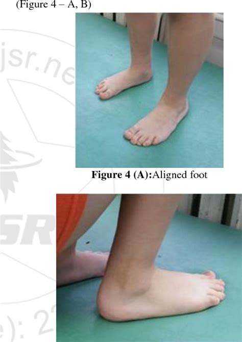 Figure 4 From The Role Of Anterior Tibial Muscle Tendon Transfer As A Miniinvasive Surgical Step