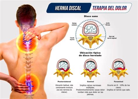 Ozonoterapia Para Dolores En La Columna Ayacucho