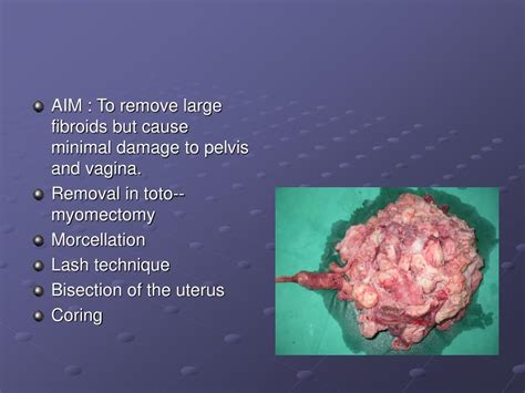 Ppt Vaginal Hysterectomy For Big Uteri Powerpoint Presentation Free