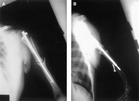 Internal Jugular Deep Venous Thrombosis After Surgical Treatment Of A