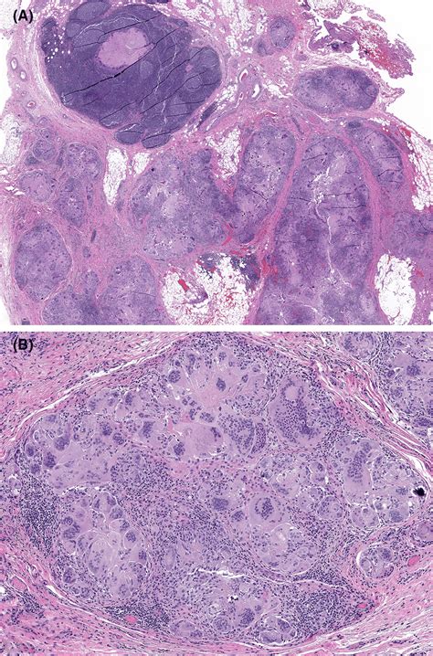 A A Lowpower View Of A Histologic Section From The Resected Level 2