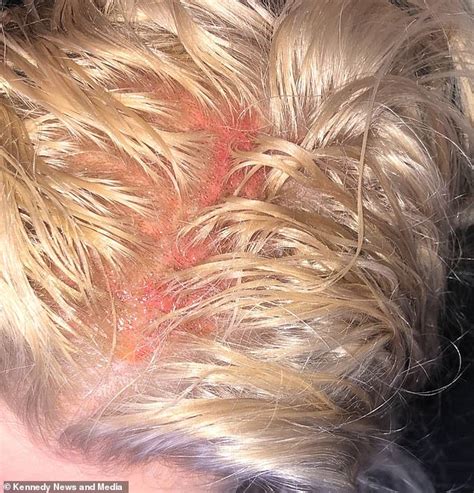 Scalp Burns From Bleach