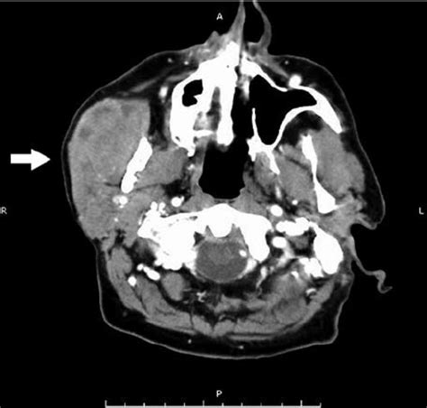 Computed Tomography Scan Revealing Enhancing Mass In Parotid Gland With Download Scientific