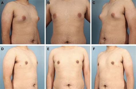 Patient With Low Rohrich Grade Gynecomastia Who Underwent Treatment