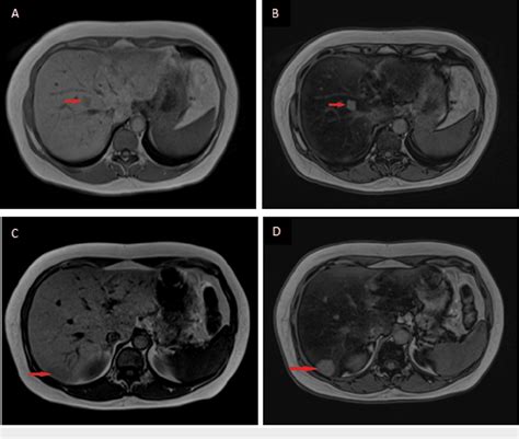 Figure 2 From Multifocal Nodular Fatty Sparing Mimicking Hepatic Tumors