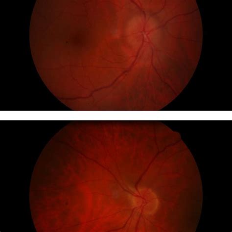 Right papillitis. Normal left eye fundus. | Download Scientific Diagram