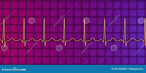 Electrocardiogram Ecg Displaying Sinus Tachycardia D Illustration