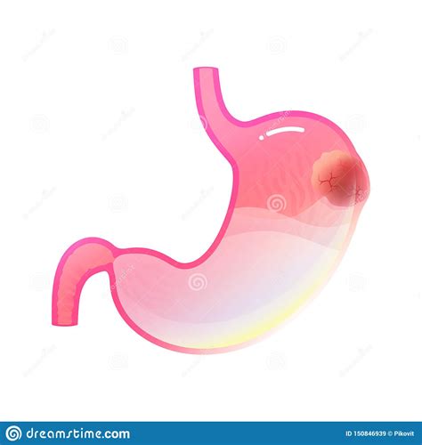 Illustration D Isolement Par Vecteur De Cancer De L Estomac